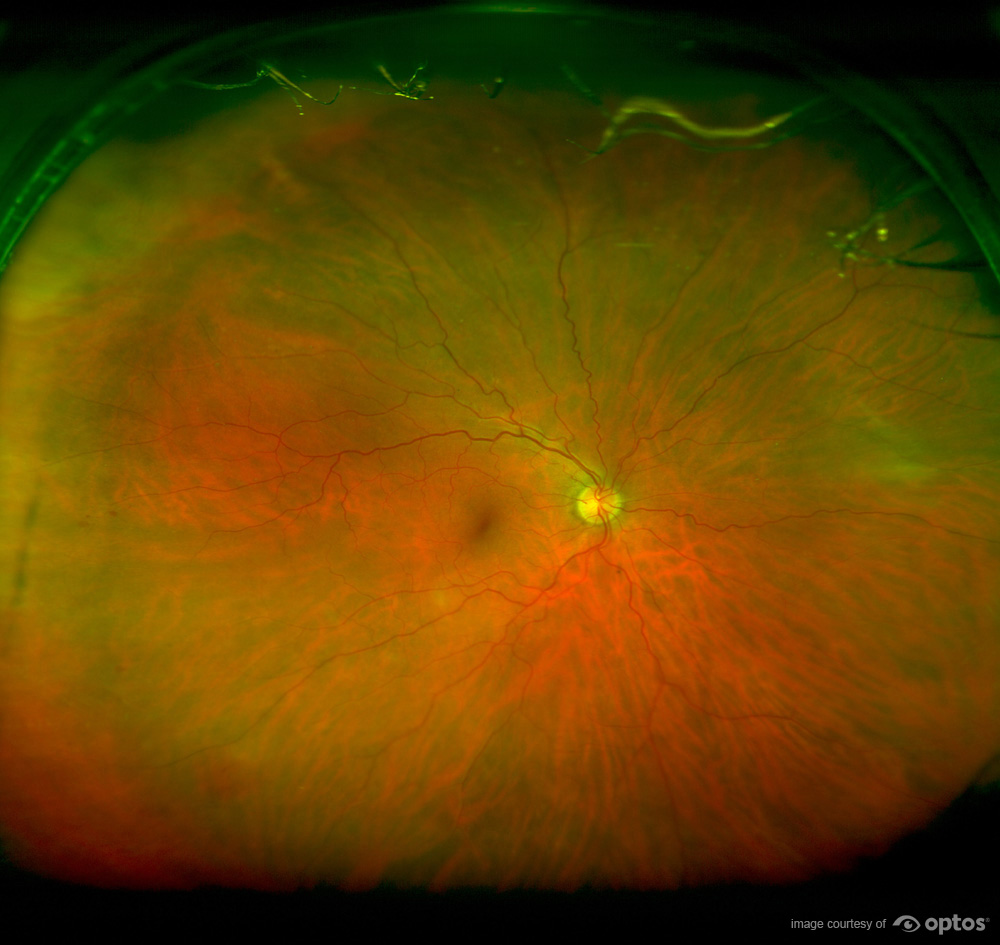 optomap retinal exam article